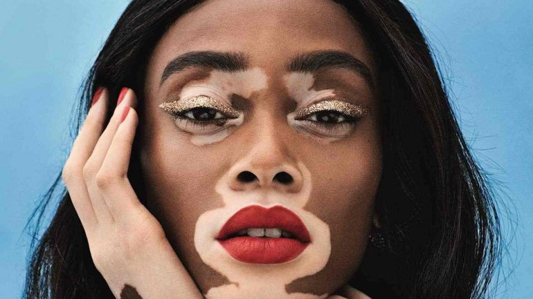 Winnie Harlow Kimdir? – Vücut Ölçüleri – Boyu – Kilosu – Göz Rengi